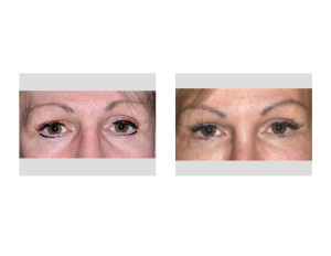 Transpalpebral Orbital Rim Contouring Right Eye result front view Dr Barry Eppley Indianapolis