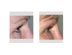 Transpalpebral Orbital Rim Contouring Right Eye result side view Dr Barry Eppley Indianapolis