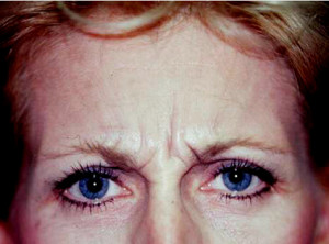 glabellar wrinkle lines for Botox Dr Barry Eppley Indianapolis