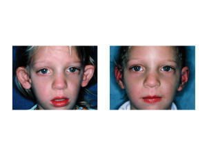 Early Otoplasty in Children Dr Barry Eppley Indianapolis