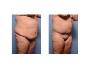 Extended Tummy Tuck result oblique view Dr Barry Eppley Indianapolis