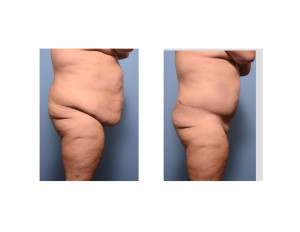 Extended Tummy Tuck results side view Dr Barry Eppley Indianapolis