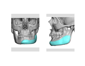 Jaw Asymmetry Implant Design Dr Barry Eppley Indianapolis