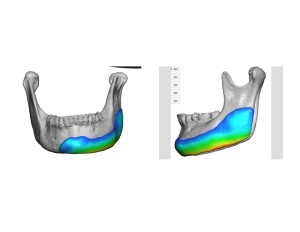 Jaw Asymmetry Implant Thickness Dr Barry Eppley Indianapolis