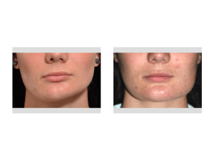 Jaw Asymmetry Surgery results front view Dr Barry Eppley Indianapolis