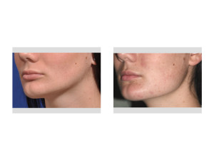 Jaw Asymmetry Surgery results oblique view Dr Barryt Eppley Indianapolis