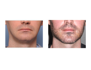 Jawline Surgery result front view Dr Barry Eppley Indianapolis