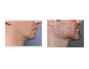 Jawline Surgery result side view Dr Barry Eppley Indianapolis