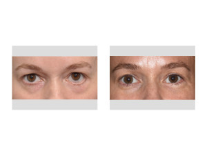 Left Lower Eyelid Reconstruction result front view Dr Barry Eppley Indianapolis