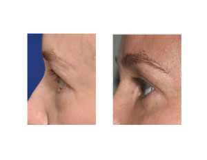 Left Lower Eyelid Reconstruction result side view Dr Barry Eppley Indianapolis