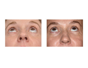 Left Lower Eyelid Reconstruction result submental view Dr Barry Eppley Indianapolis
