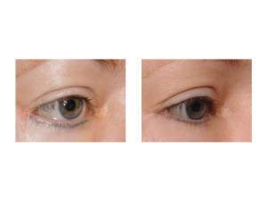 Lower Ectropion Repair oblique view Dr Barry Eppley Indianapolis