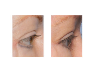 Lower Eyelid Ectropion Repair side view Dr Barry Eppley Indianapolis