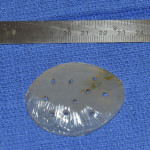 Small Skull Implant Dr Barry Eppley Indianapolis