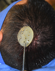 Small Skull Implant Indianapolis Dr Barry Eppley