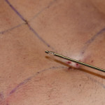 Abdominal Etching Basket Cannula Dr Barry Eppley Indianapolis