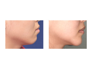 Asian Chin Reshaping result side view Dr Barry Eppley Indianapolis