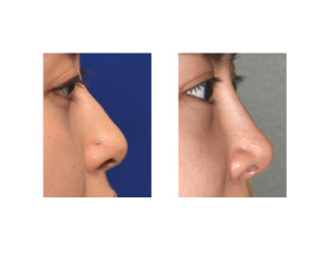 Asian Female Implant Rhinoplasty Dr Barry Eppley Indianapolis