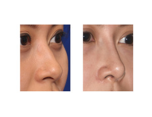 Asian Female Implant Rhinoplasty oblique view Dr Barry Eppley Indianapolis
