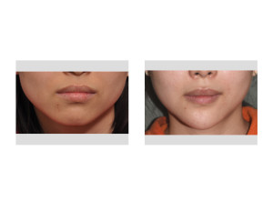 Asian Female Jawline Narrowing result Dr Barry Eppley Indianapolis