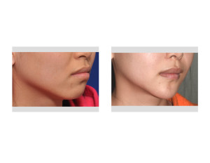 Asian Female Jawline Reshaping result oblique view Dr Barry Eppley Indianapolis