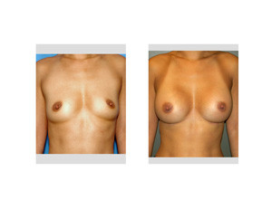 Breast Augmentation in Asians Dr Barry Eppley Indianapolis