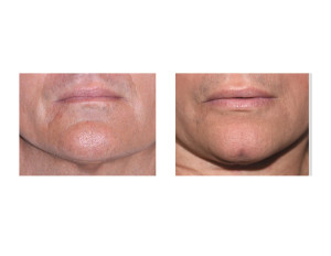 Chin Cleft Creation Surgery result front view Dr Barry Eppley Indianapolis