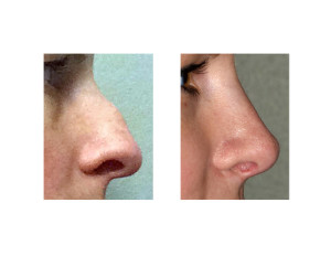 Hump Reduction Rhinoplasty result 3 side view Dr Barry Eppley Indianapolis