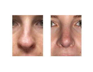 Hump Reduction Rhinoplasty result front view Dr Barry Eppley Indianapolis