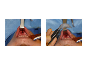 Intraoral Chin Implant Placement Technique Dr Barry Eppley Indianapolis