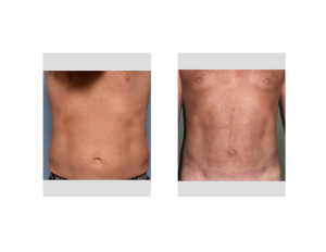 LW Abdominal Etching result front view