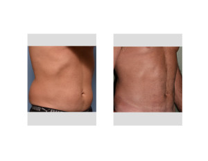 LW Abdominal Etching result oblique view