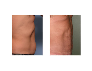 LW Abdominal Etching result side view