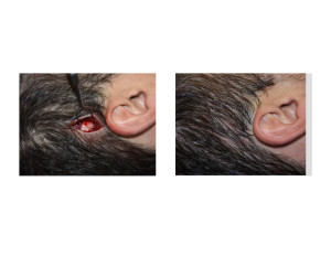 Limited Incision POsterior Temporal Reduction technique 2 Dr Barry Eppley Indianapolis