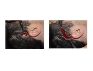 Limited Incision Posterior Temporal Reduction technique Dr Barry Eppley Indianapolis