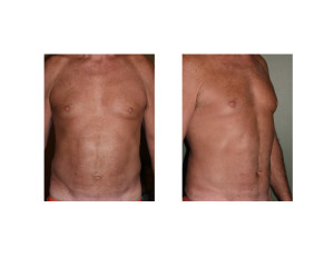 Middle Aged Male Abdominal Etching results Dr Barry Eppley Indianapolis