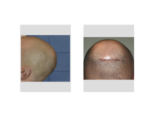 Minimal Incision Occipital Cranioplasty incision Dr Barry Eppleyh Indianaspolis