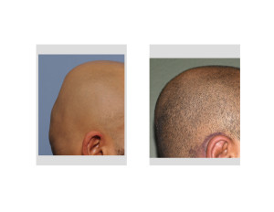 Minimal Incision Occipital Cranioplasty with PMMA result left side view Dr Barry Eppley Indianapolis