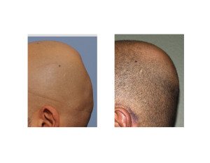 Minimal Incision Occipital Cranioplasty with PMMA result side view Dr Barry Eppley Indianapolis