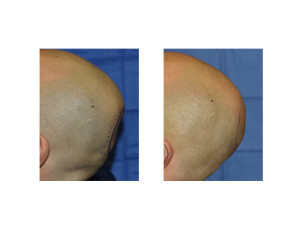 Occipital Cranioplasty intraoperative result Dr Barry Eppley Indianapolis