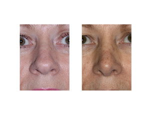 Overprojecting Nose Rhinoplasty result front view Dr Barry Eppley Indianapolis