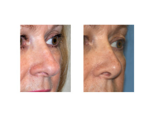 Overprojecting Nose Rhinoplasty result oblique view Dr Barry Eppley Indianapolis
