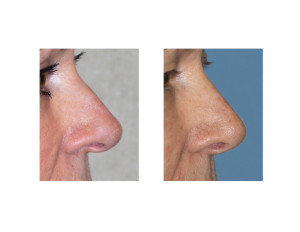 Overprojecting Nose Rhinoplasty result side view Dr Barry Eppley Indianapolis
