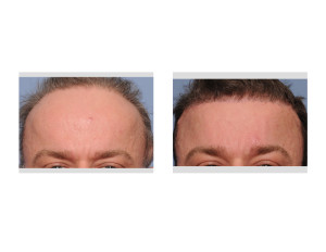 Total Forehead Reduction result front view Dr Barry Eppley Indianapolis