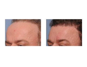 Total Forehead Reduction result oblique view Dr Barry Eppley Indianapolis