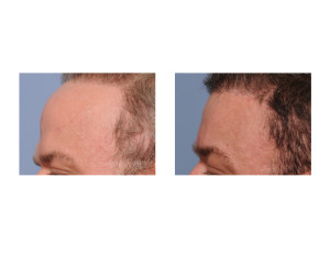 Total Forehead Reduction result side view Dr Barry Eppley Indianapolis
