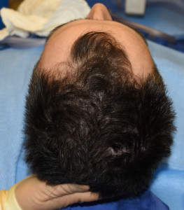 left posterior temporal reduction result intraop dr barry eppley indianapolis