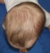plagioccephaly