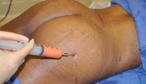 Buttock Fat Injections Dr Barry Eppley Indianapolis