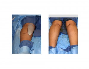 Calf Implant Size Adjustments Dr Barry Eppley Indianapolis